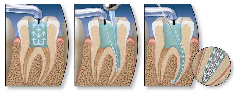 endodoncija