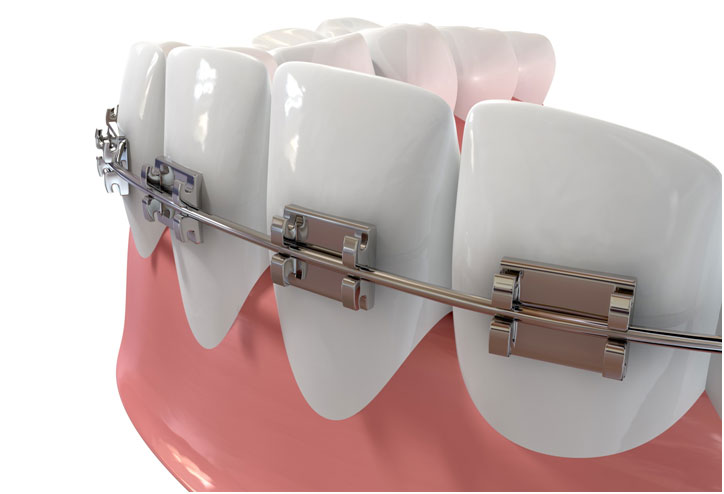 fiksne proteze za zube