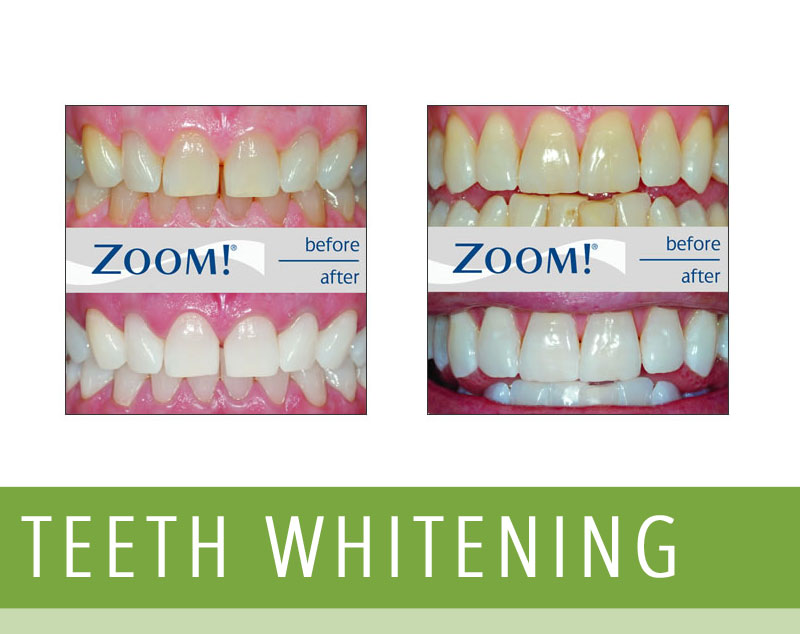 Teeth Whitening Philips Zoom