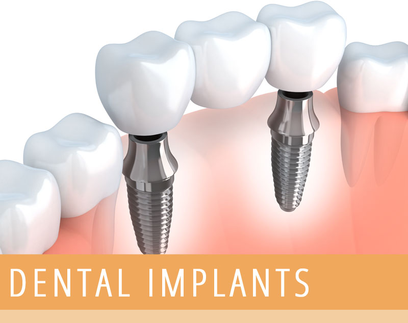 dental Implants belgrade